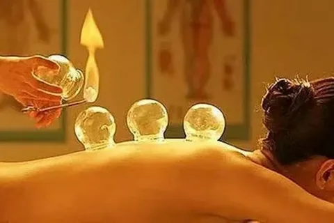 cupping therapy melbourne, cupping treatment melbourne