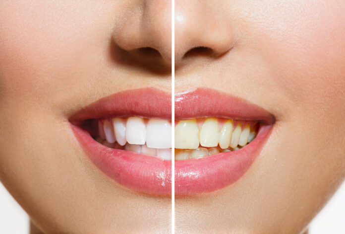 Teeth Whitening Marrickville