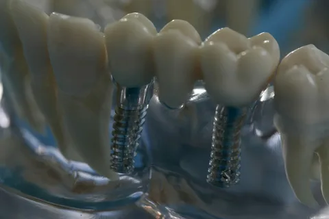 dental implants leichhardt